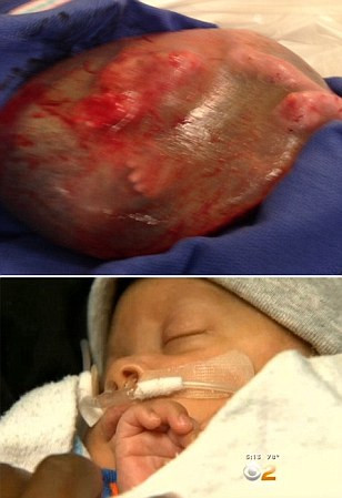 Các bác sĩ cho rằng đây là một ca cực kỳ hiếm, chỉ xuất hiện 1 trong 80.000 ca sinh nở.