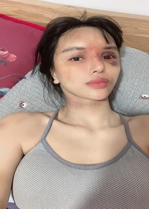 Trước hot girl Lâm Minh, không ít mỹ nhân Việt công khai bị bạo hành. Khả Trang là một trong số đó. Tháng 7/2022, Khả Trang tung loạt ảnh tố bị bạo hành dã man. Mắt cô đỏ ngầu, mũi như bị gãy, vùng đầu, lưng đều có vết bầm tím. Người đẹp phải nhập viện vì thương tích đầy mình. Ảnh: FBNV.