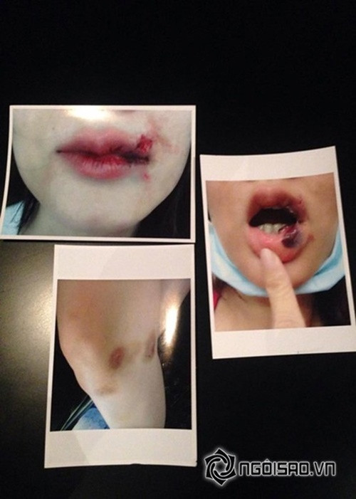 Tháng 9/2015, Dương Yến Ngọc tung bằng chứng bị chồng cũ đánh đập, hăm dọa sau khi ly hôn. Ngoài ra, cô còn quyết định kiện chồng cũ và giành lại con trai tại tòa. Ảnh: FBNV.