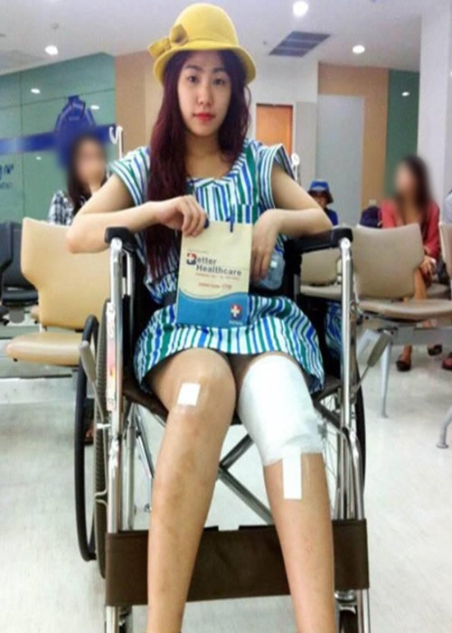 Năm 2011, khi đang trên đỉnh cao sự nghiệp, Lương Bích Hữu gặp tai nạn khiến chân phải bị bỏng nặng ở cấp độ 2, phần má hai bên cũng cháy xém. Ảnh: Vietnamnet.