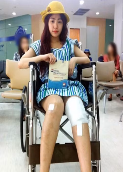 Năm 2011, khi đang trên đỉnh cao sự nghiệp, Lương Bích Hữu gặp tai nạn khiến chân phải bị bỏng nặng ở cấp độ 2, phần má hai bên cũng cháy xém. Ảnh: Vietnamnet.