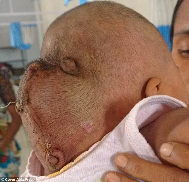 Sau thời gian dài điều trị không thành công, Yamanoor đã được các bác sĩ tại bệnh viện ở Bangalore phẫu thuật cắt bỏ u nang do hội chứng thoát vị não gây ra. Các bác sĩ đánh giá đây là ca phẫu thuật rất phức tạp vì bé còn quá nhỏ và có nhiều nguy cơ bị mất nhiều máu và thiếu máu trong khi phẫu thuật. 