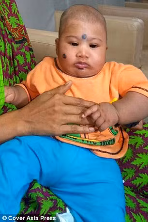 Bé Yamanoor Naranal (5 tháng tuổi - người Ấn Độ) từ khi sinh ra đã có một u nang lớn ở sau đầu. U nang to gần bằng đầu khiến Yamanoor Naranal trông như một cậu bé hai đầu.