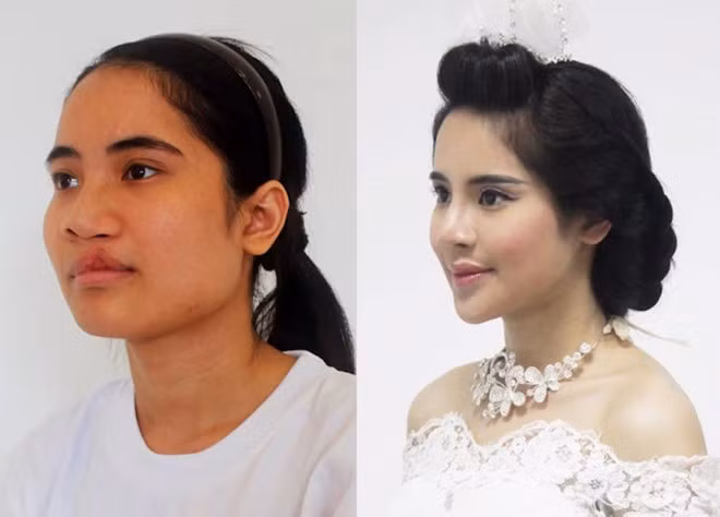 Co gai ho ham ech xinh dep nho phau thuat tham my-Hinh-2