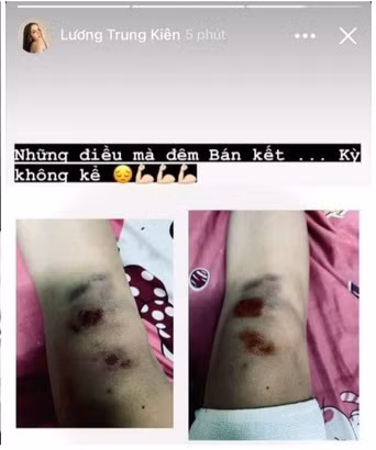 Đi kèm với bức ảnh đôi chân bầm dập, người đẹp chuyển giới - Lương Mỹ Kỳ đăng kèm dòng trạng thái: "Những điều mà đêm Bán kết… Kỳ không kể."