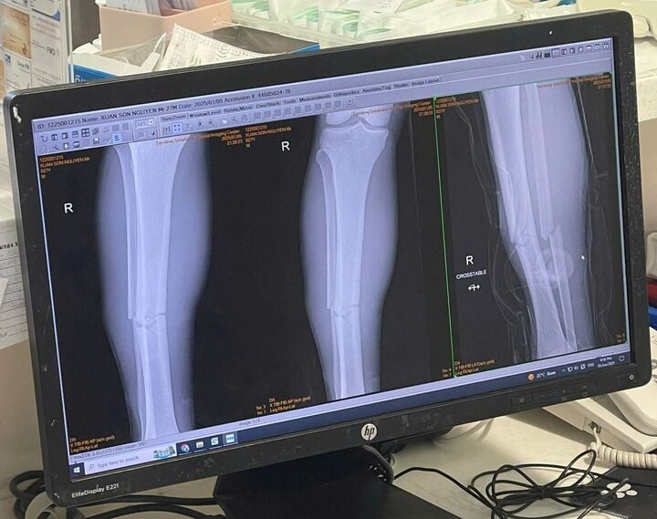 Ảnh chụp X quang chiếc chân của Xuân Son.