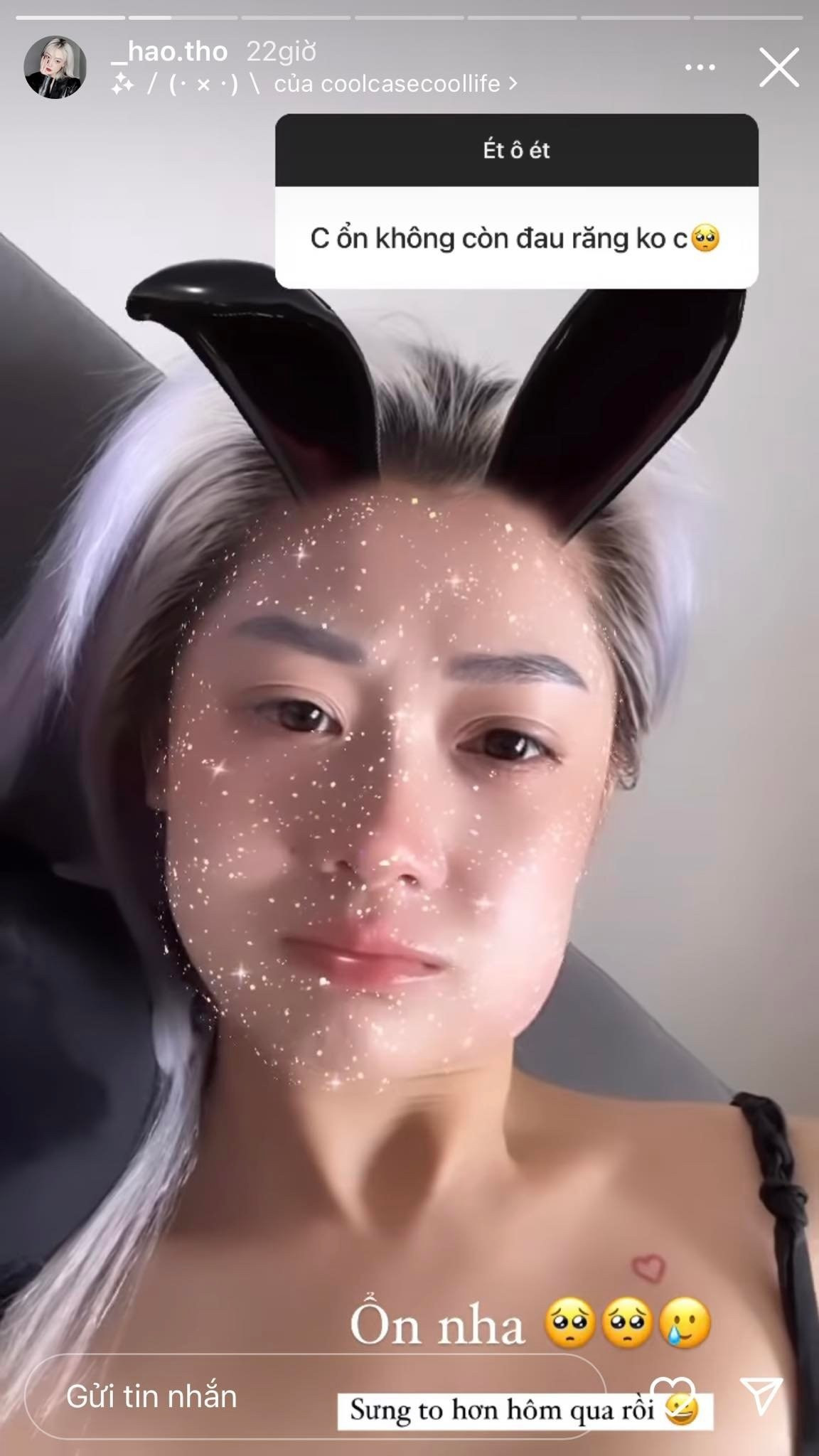 Cụ thể là sau vài ngày bị răng khôn hành cho đau âm ĩ, thì nữ streamer này quyết định tìm đến nha khoa để xử lý.