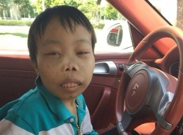 Do mắc hội chứng Thalassemia (hội chứng thiếu máu di truyền Địa Trung Hải) nên khuôn mặt Trần Sơn bị biến dạng, chiều cao cũng khiêm tốn nhưng cô dâu của anh chàng không lấy đó làm ngại.