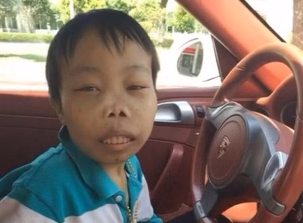 Do mắc hội chứng Thalassemia (hội chứng thiếu máu di truyền Địa Trung Hải) nên khuôn mặt Trần Sơn bị biến dạng, chiều cao cũng khiêm tốn nhưng cô dâu của anh chàng không lấy đó làm ngại.