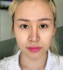 Cụ thể, Huyền Anh từng chia sẻ: "Tôi đã sửa hai lần. Lần đầu ở Thái Lan, cùng làm với mũi. Lần thứ hai tại Việt Nam, do các bác sĩ Hàn Quốc thực hiện. Sau phẫu thuật nâng ngực khoảng một tuần thì vết thương lành và tôi đi lại bình thường".