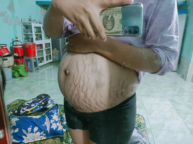 Mang thai là lúc người phụ nữ phải đánh đổi nhiều thứ kể cả sức khỏe hay ngoại hình. Nhiều người bị tăng cân quá đà, mụn mọc nhiều hơn hay làn da sần sùi, tóc rụng...