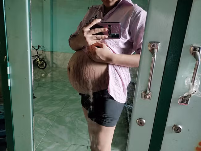 Chưa kể đến trường hợp khi em bé ngày càng lớn, vòng 2 của các mẹ bầu sẽ to ra khiến tình trạng rạn da ngày càng nghiêm trọng.