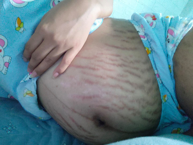 Việc rạn người không chỉ về vấn đề thẩm mỹ mà nhiều chị em còn khó chịu bởi chúng gây ra cảm giác ngứa rát.