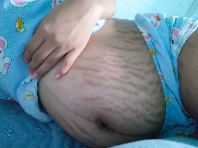 Việc rạn người không chỉ về vấn đề thẩm mỹ mà nhiều chị em còn khó chịu bởi chúng gây ra cảm giác ngứa rát.