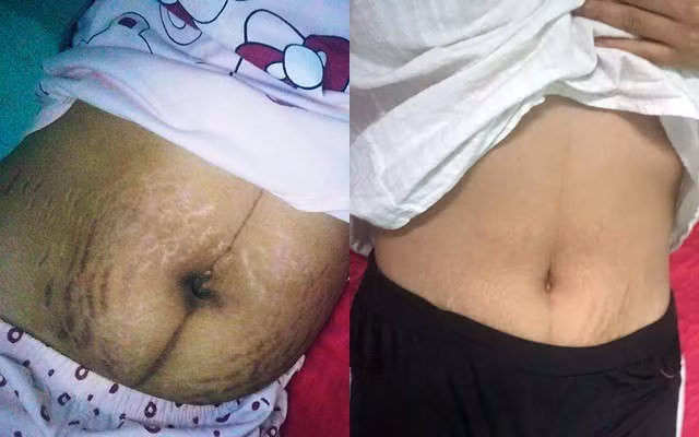 Mặc dù chị C. mang bầu bụng không quá lớn, thế nhưng những vết rạn lại xuất hiện sớm và ngày càng nhiều.