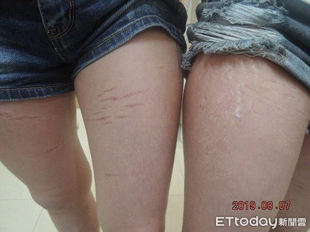 Chẳng riêng gì rạn da, chị C. trong suốt thai kỳ còn gặp nhiều vấn đề nghiêm trọng khác như thâm cổ, thâm nách hay đau đầu, chân bị nhức mỏi thường xuyên…