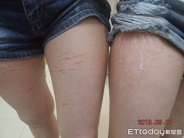 Chẳng riêng gì rạn da, chị C. trong suốt thai kỳ còn gặp nhiều vấn đề nghiêm trọng khác như thâm cổ, thâm nách hay đau đầu, chân bị nhức mỏi thường xuyên…