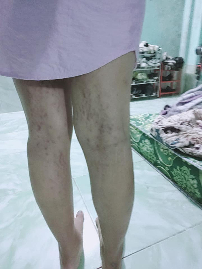 Mới đây, mạng xã hội đã chia sẻ hình ảnh một bà mẹ bầu tên C. ở Bến Cát, Bình Dương với bụng bầu chi chít những vết rạn to đùng.