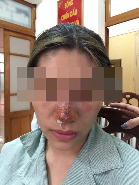 Thời gian gần đây, trên mạng xã hội hình ảnh kinh dị khi chỉ vì tin theo lời quảng cáo đã tiêm filler quá đà khiến toàn bộ khuôn mặt biến dạng.