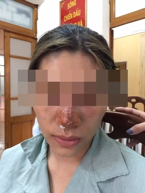 Thời gian gần đây, trên mạng xã hội hình ảnh kinh dị khi chỉ vì tin theo lời quảng cáo đã tiêm filler quá đà khiến toàn bộ khuôn mặt biến dạng.