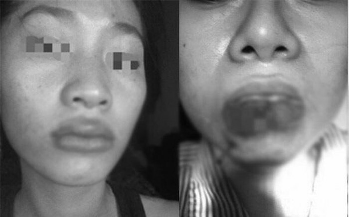 Một trường hợp vì quá lạm dụng tiêm filler mà khiến đôi môi bị biến dạng và hoại tử.