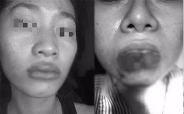 Một trường hợp vì quá lạm dụng tiêm filler mà khiến đôi môi bị biến dạng và hoại tử.