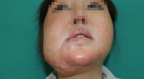 Chỉ vì quá lạm dụng filler mà người phụ nữ này biến dạng lệch cả gương mặt.