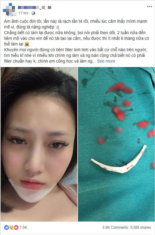 Do tiêm filler dởm, cô gái trên nhận cái kết quả thực không ai muốn.