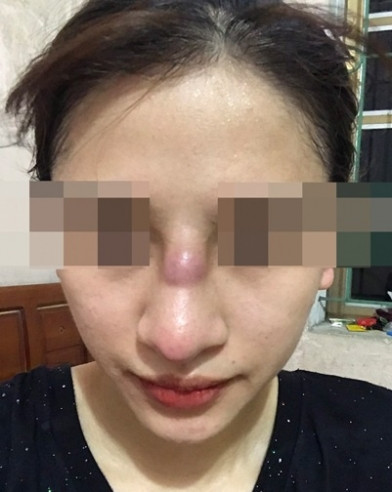 Do tiêm filler quá đà nên một cô nàng bị xưng một cục u ngay trên mũi.