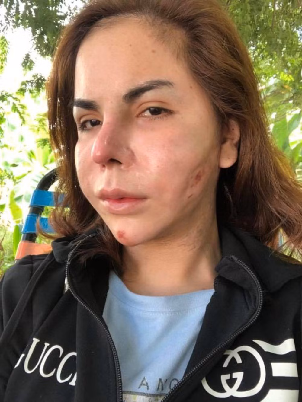 Bên cạnh những người thực hiện không có kiến thức, lỗi một phần trong các ca biến tướng vì filler cũng bởi do chính người dùng. Họ không ý thức được tác hại của chất làm đầy và quá tham lam vì muốn tiêm cho thật nhiều.