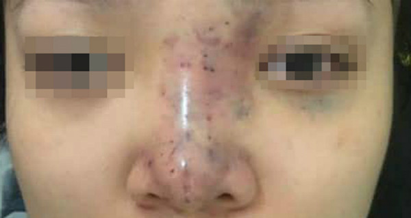 Ngày càng nhiều những sự việc đáng tiếc như thế khi lạm dụng tiêm filler. Lý do, nhiều spa mọc và những người không có chuyên môn thực hiện tiêm chất làm đầy, thậm chí còn công khai quảng cáo tràn lan trên mạng xã hội.