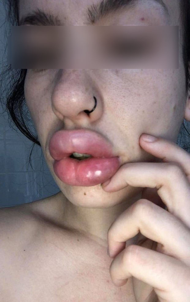 Thêm một trường hợp do tiêm filler dẫn tới việc đôi môi bị biến dạng.