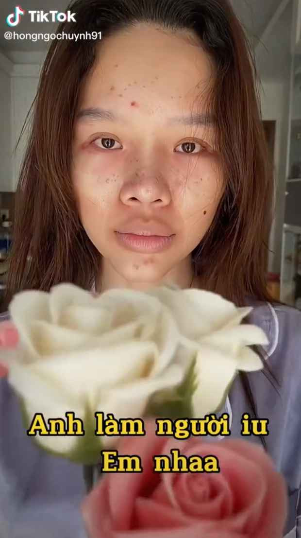 “Trước khi đến mình đã tìm hiểu về bệnh viện, gửi hình ảnh mũi của mình để bác sĩ xem trước và tìm kiểu dáng phù hợp với mình. Vì mũi lần trước của mình bị gãy, nên mình phải đi sửa lại… Tổng chi phí mình bỏ ra cho chuyến phẫu thuật lần này là 300 củ”, Jimin Young chia sẻ trong clip.