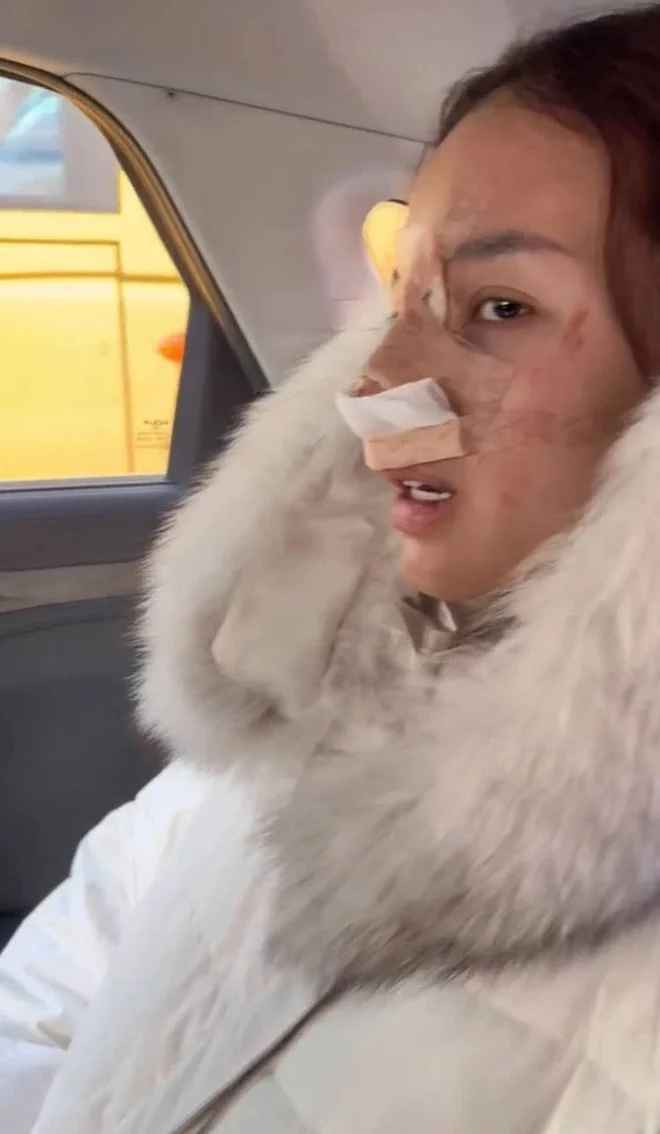 Được biết, đây là lần thứ 2 Jimin Young can thiệp “dao kéo” để có một chiếc mũi cao hơn, đẹp hơn. Nhưng do lần đầu tiên phần sống mũi bị gãy, chưa được ưng ý nên cô phải sang Hàn để phẫu thuật lại.