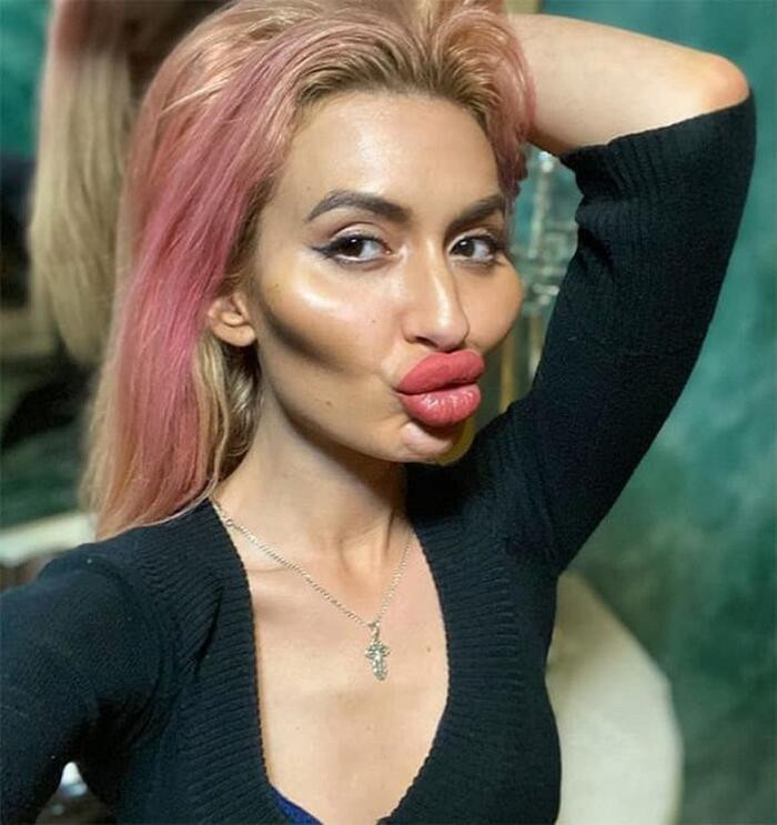 Dù gặp nhiều lời chê về nhan sắc sau màn bơm filler quá đà. Tuy nhiên, Anastasia vẫn chưa có ý định dừng lại.