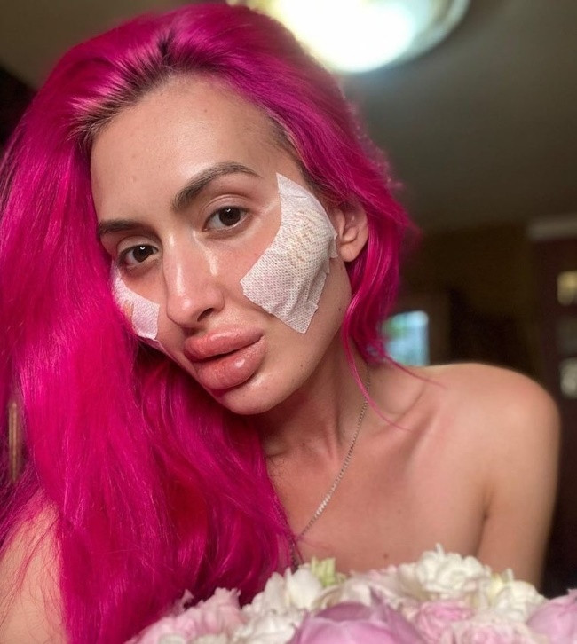 Thậm chí, Anastasia từng chia sẻ: "Tôi yêu chúng, tôi luôn muốn khuôn mặt phải như ý mình và tôi hài lòng với điều đó. Tôi cũng tự chích nhiều nơi trên mặt. Nhiều người bảo tôi là thứ dở hơi xấu xí và nên tự sát đi. Tôi chỉ cười và bỏ qua thôi".