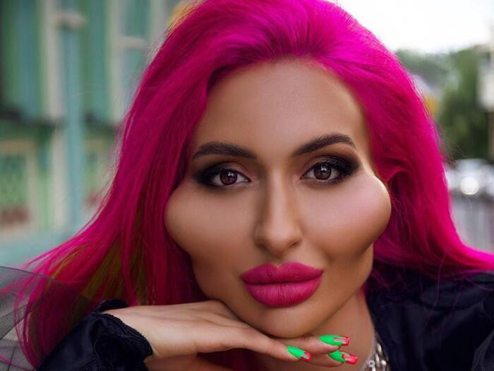 Không chỉ bơm má, Anastasia còn chỉnh môi, khóe miệng. Cô cũng tiêm thêm botox vào trán, cằm và 2 bên quai hàm để tạo hình.