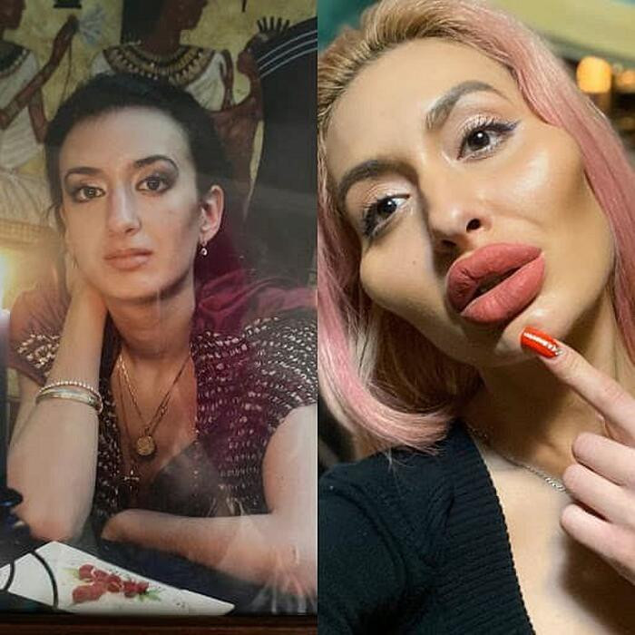 Đường nét nhỏ nhắn ngày nào của cô nàng người mẫu Ukraine bị thay thế hoàn toàn sự cứng đờ bởi filler.