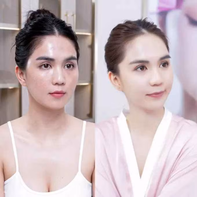 Trên thực tế, để sở hữu làn da trắng bóc không tì vết, Ngọc Trinh luôn thẳng thắn thừa nhận có tắm trắng và truyền trắng từ năm 2009.