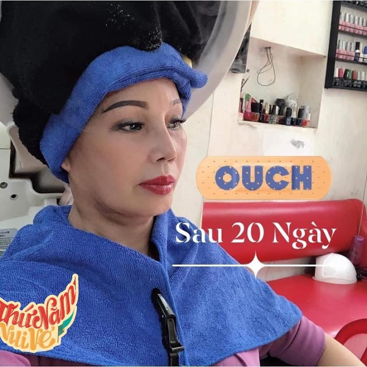 Theo những hình ảnh mới nhất, nhan sắc của cô dâu Thu Sao khá khẩm hơn nhiều lần trước, gương mặt không còn méo xẹo, khuôn miệng lệch hẳn sang một bên và làn da sau khi được trị nám đã căng bóng, sáng mịn hơn rất nhiều.