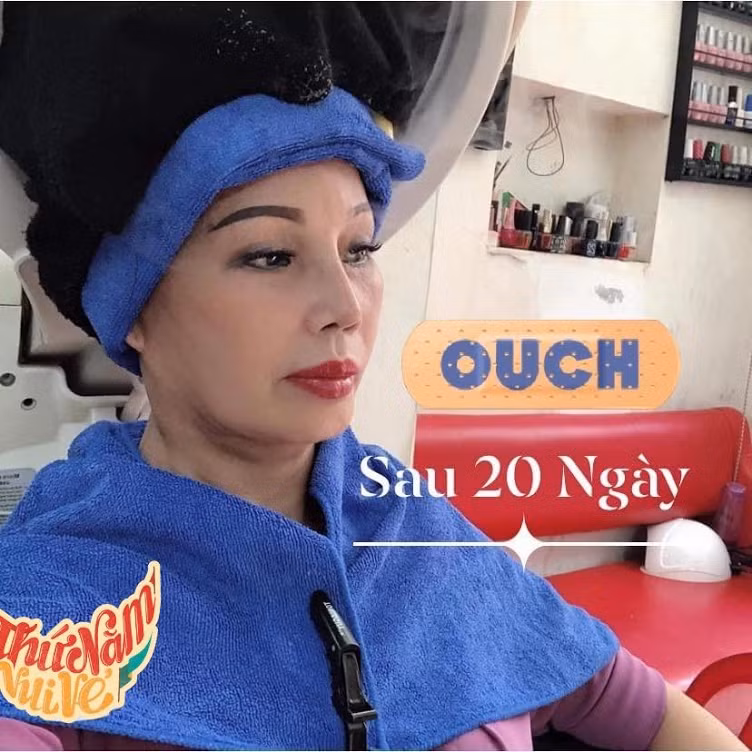 Theo những hình ảnh mới nhất, nhan sắc của cô dâu Thu Sao khá khẩm hơn nhiều lần trước, gương mặt không còn méo xẹo, khuôn miệng lệch hẳn sang một bên và làn da sau khi được trị nám đã căng bóng, sáng mịn hơn rất nhiều.