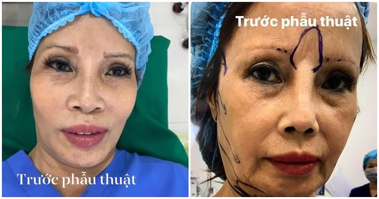 Những ngày qua, hình ảnh liên quan đến cuộc phẫu thuật thẩm mỹ của cô dâu 62 tuổi thu hút sự chú ý của nhiều người. Sau hơn 20 ngày hoàn thành các liệu trình "dao kéo", cô Thu Sao xuất hiện trên trang cá nhân với gương mặt được tháo băng hoàn toàn.