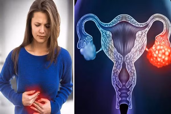 Nếu bạn có 10 dấu hiệu này, hãy nghi ngờ ung thư buồng trứng Neu ban co 10 dau hieu nay, hay nghi ngo ung thu buong trung