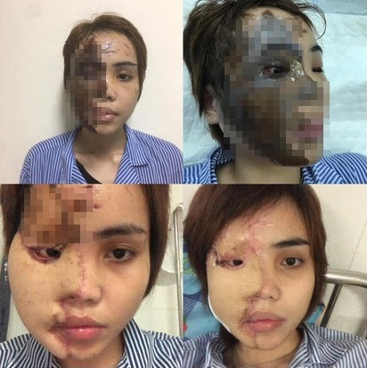 Trời không phụ lòng người, những vết sẹo do vụ tạt axit chưa biến mất nhưng nó cũng đang mờ dần.