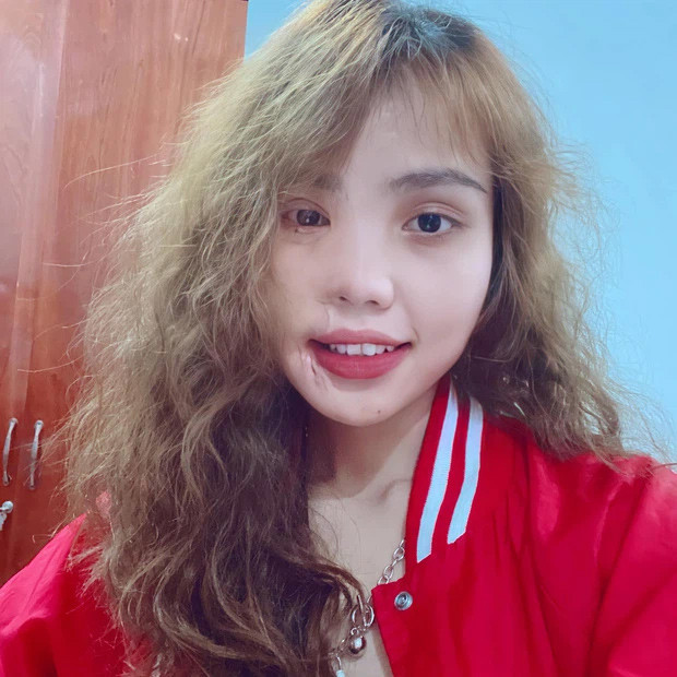 Phần gương mặt bị cháy sém do tạt axit đang dần phục hồi. Được biết, các bác sĩ đã sử dụng da ở lưng, đùi để ghép vào phần bị tổn hại.