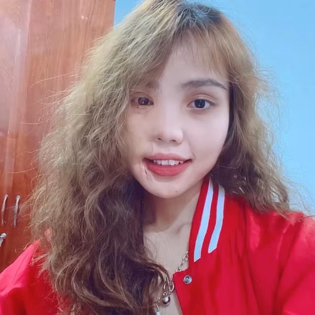 Phần gương mặt bị cháy sém do tạt axit đang dần phục hồi. Được biết, các bác sĩ đã sử dụng da ở lưng, đùi để ghép vào phần bị tổn hại.