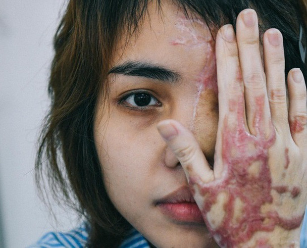 Cô gái bị tạt axit nói trên đang được nhắc tới trong câu chuyện có tên Lê Thị Lan Vy (26 tuổi, trú tại quận Thanh Khê, Đà Nẵng).