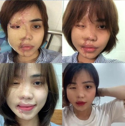 Tính đến thời điểm hiện tại, nạn nhân đã trải qua gần 20 ca phẫu thuật lớn nhỏ với mong muốn diện mạo được cải thiện hơn.