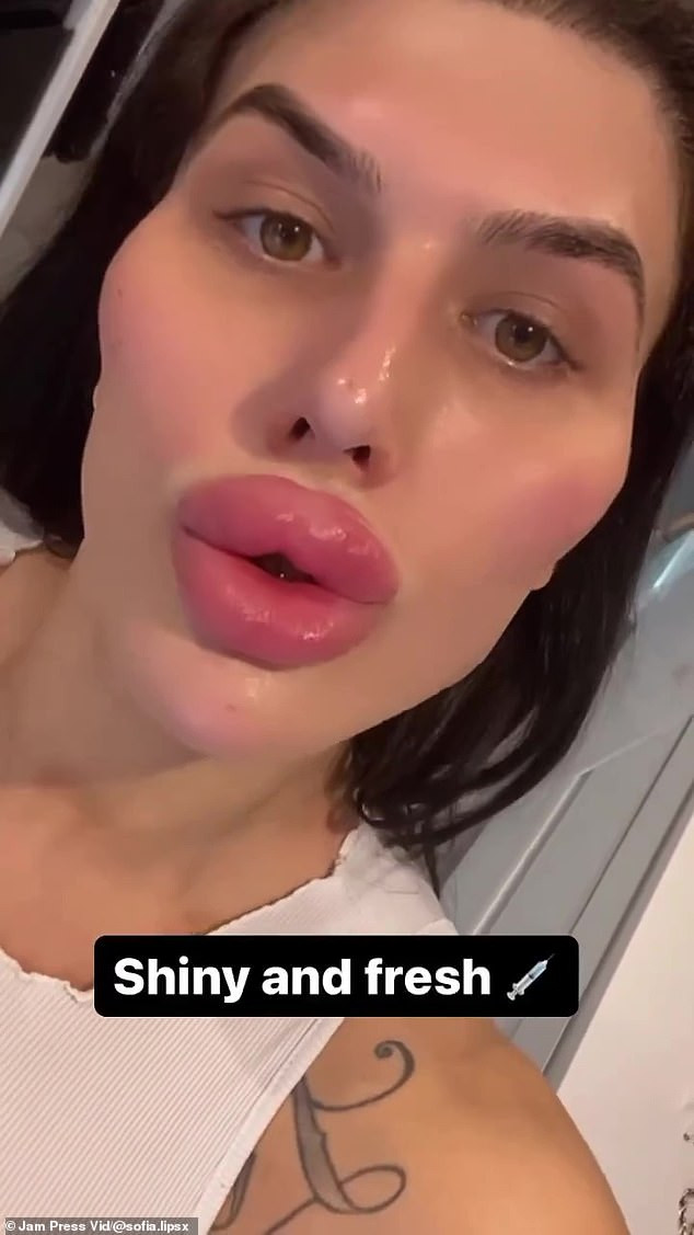 Sofia Lips thường xuyên cập nhật trên Instagram về các quy trình mới của mình, nhưng những người hâm mộ cuồng nhiệt đã kêu gọi cô dừng lại, thậm chí một số người còn gọi cô là "quái vật".