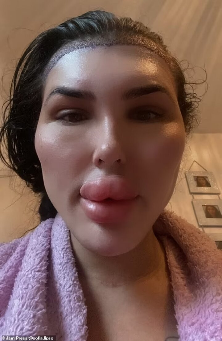 Sofia nói thêm: “Tôi cũng thường xuyên tiêm Botox và tiêm má vì để có được kết quả như ý muốn thì rất tốn kém. Tôi muốn trông giống búp bê tuyệt đỉnh”.